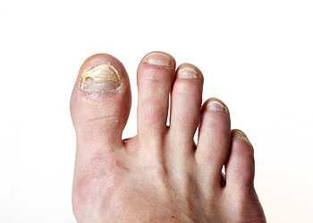 Tinea unguium effecting the toe nails. Diagnosis: Onychomycosis