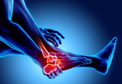 Rheumatoid Arthritis in the Feet