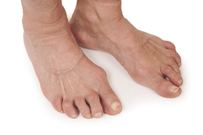 Rheumatoid Arthritis and the Feet