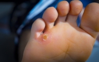 Causes and Treatment of Corns on the Feet