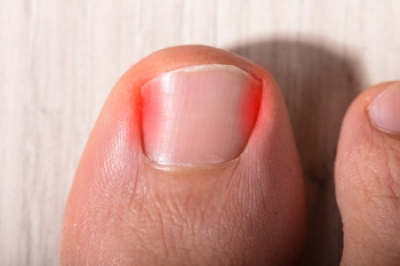 Does My Child Have an Ingrown Toenail?