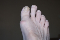 Causes of Second Toe Pain