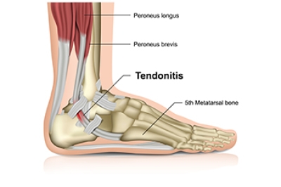 Facts About the Achilles Tendon and Potential Injuries