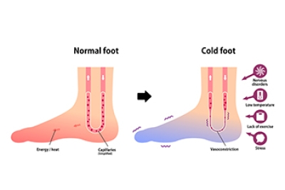Cold Toes May Indicate Raynaud’s Phenomenon