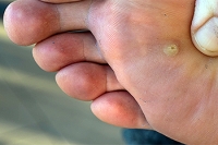 HPV and Plantar Warts