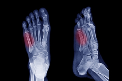 Recovery From a Jones Fracture
