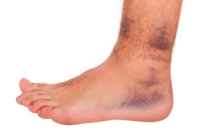 Are Foot And Ankle Injuries Common?