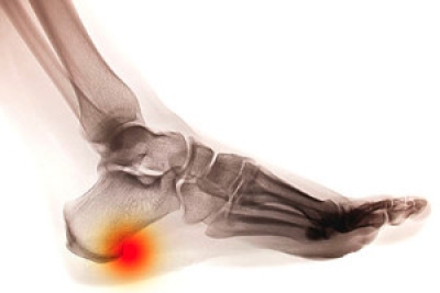 What is a Common Source of Heel Pain?