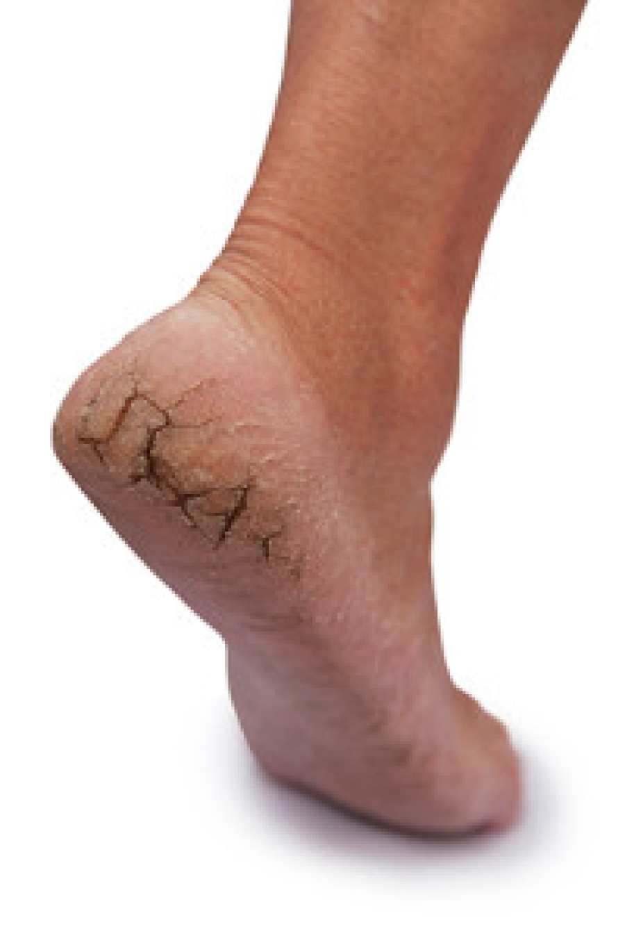 Cracked Heels: Causes and Prevention - Hurst Podiatry