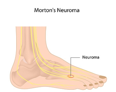 What Can Trigger Morton’s Neuroma?