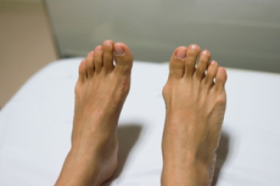 Care and Treatment of Bunions