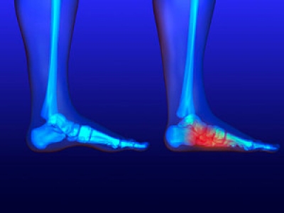 Flat Feet May Gradually Disappear with Age