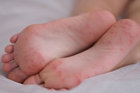 Causes and Symptoms of an Infected Foot