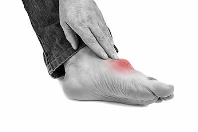 Painful Gout Attacks