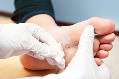 Are Plantar Warts Contagious?