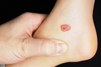 What Are the Causes of Foot Blisters?