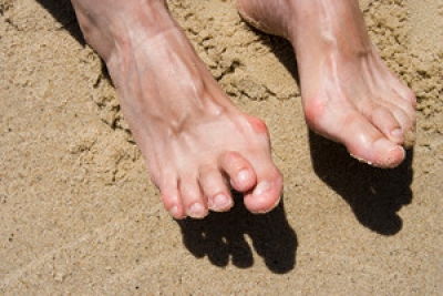 Everything to Know About Hammertoe