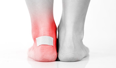 How to Prevent Blisters on the Feet