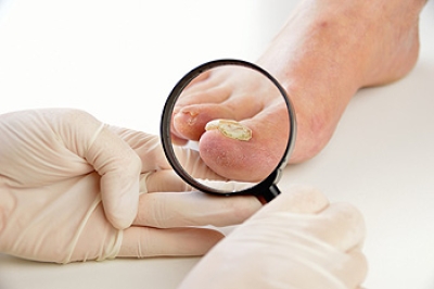 Can Toenail Fungus Be Prevented?
