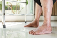 Systemic Sclerosis and Foot Health